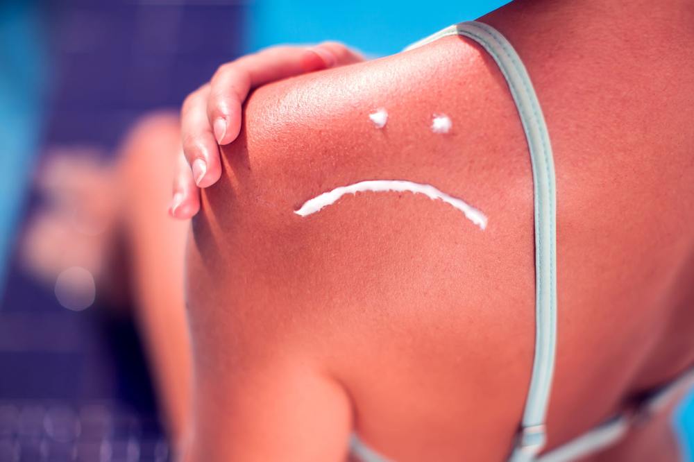 3 Ways To Cure Your Sunburn Naturally