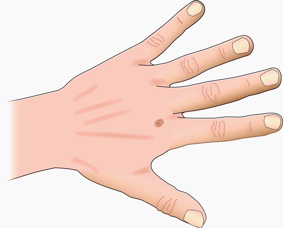 The Best Home Remedies For Hand Warts